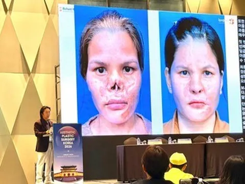 Giải pháp điều trị biến chứng sau nâng mũi gây chú ý tại Hội nghị thẩm mỹ quốc tế APS Korea 2026